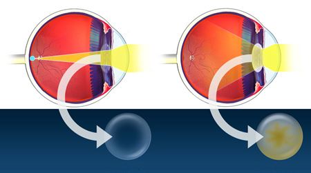 Staar of cataract